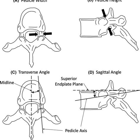 Diagrams Of The Four Important Vertebrae Dimensions For Surgical