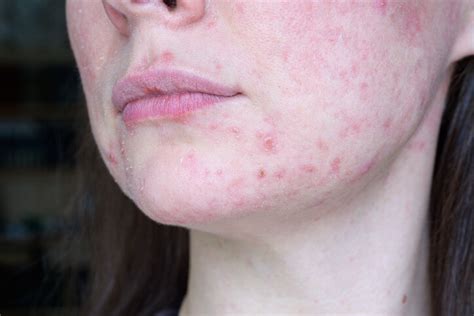 What Is In Acne Medication Breakthrough Phage Based Formulation