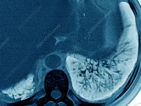 Cystic fibrosis (cf) is an inherited disorder that causes severe damage to the lungs, digestive although cystic fibrosis is progressive and requires daily care, people with cf are usually able to. Cystic Fibrosis, CT Scan - Stock Image - C027/2486 ...