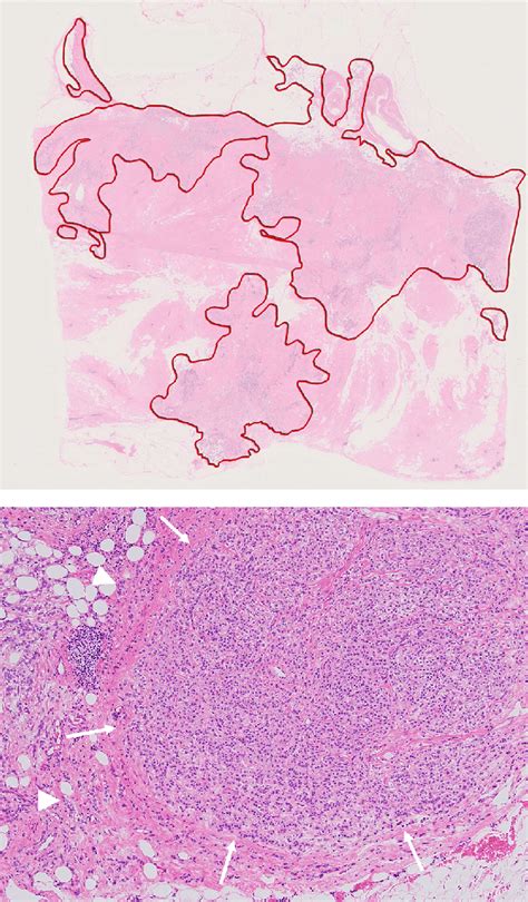 Histopathology Of The Left Breast Cancer And The Axillary Lymph Node