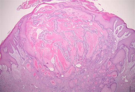 Keratoacanthoma Squamous Cell Carcinoma Of The Keratoacanthoma Type