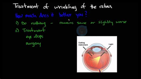 Treatment Of Wrinkling Of The Retina Youtube