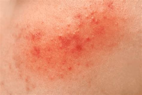 Skin Rashes With Pictures