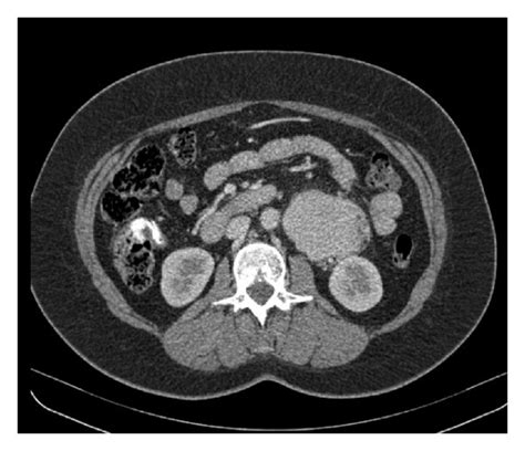 Preoperative Abdominal Computed Tomography Ct Scan Depicting A