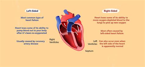 Left Sided Heart Failure Causes Symptoms And Treatment Dr Raghu
