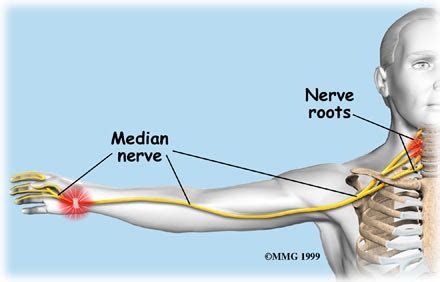 The triangular fibrocartilage is located on the pinky side of the wrist. Carpal Tunnel Syndrome vs. Cervical Radiculopathy - Three ...