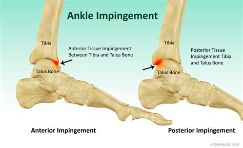 Anterior Ankle Impingement Book In At Podiatry Hq