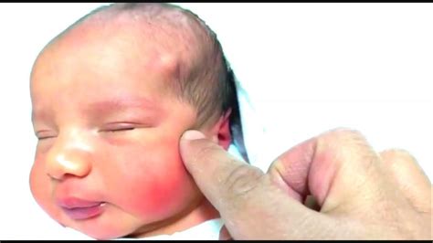 Case 674 Visual Initial Newborn Assessment Scalp Dermoid Cyst