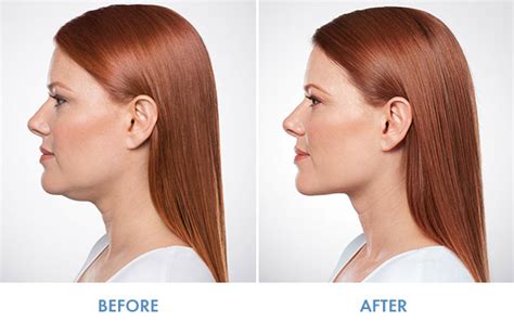 Kybella Double Chin Elimination Dermatologist In Toledo Oh Anders