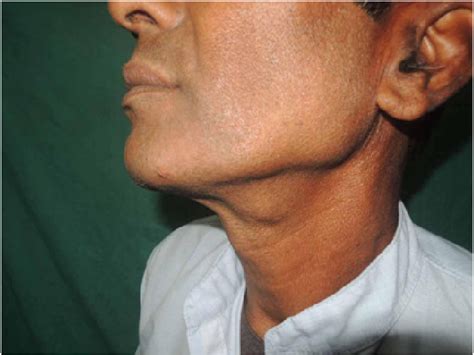 Lateral View Of The Left Side Of Neck Showing Swelling In Left