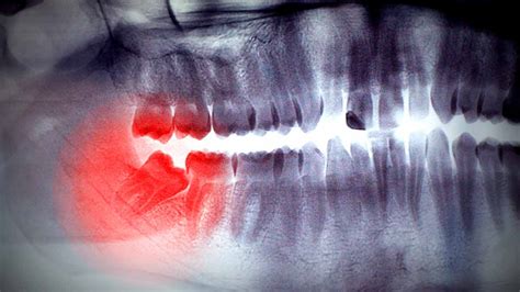 Extractions And Wisdom Teeth Removal Greenwood Walton Dentistry