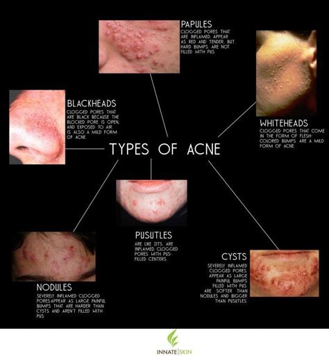 What Type Of Acne Do You Have Types Of Acne Skin Care Acne Skin