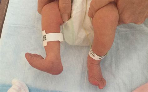 Foot Deformity At Time Of Delivery In A Premature Infant Aafp
