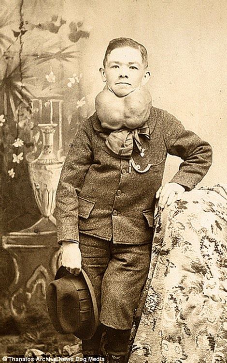 Photographic Archive Of 19th Century Deformities Released Daily Mail