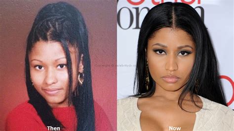 Nicki Minaj Plastic Surgery Before And After Celebrity Dr