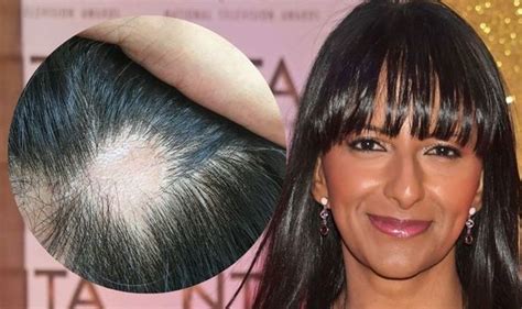 Ranvir Singh Opens Up About Alopecia Hair Loss Symptoms Uk