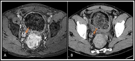 Mri And Ct Of The Pelvis T1 Weighted Axial Images Post Gadolinium A