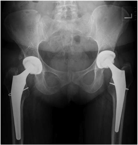 Intraoperative Proximal Femoral Fracture In Primary Cementless Total