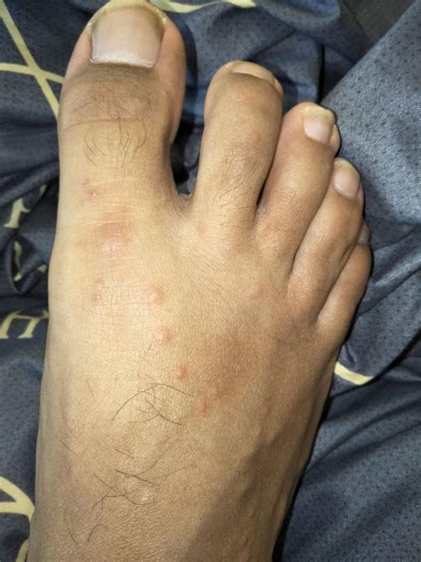 Mosquito Bites On Feet Deals Discounts Save 52 Jlcatjgobmx