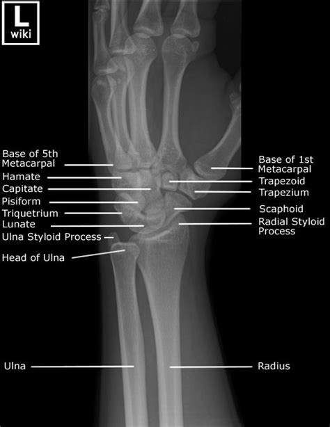Wrist Radiographic Anatomy Wikiradiography Radiology Student