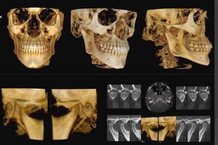 Radiographie Maxillo Faciale CT Scan Clinique Dentaire Tremblay