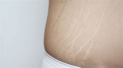 Stretch Marks 101 All You Need To Know Mederma®