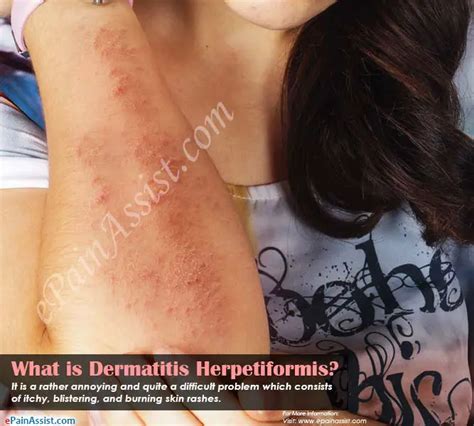 Dermatitis Herpetiformis Causes Symptoms Treatment Prognosis The Best Porn Website