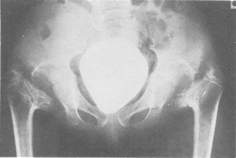 Radiograph Of The Pelvis At 12 Years Of Age Each Hip Shows Coxa Vara
