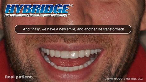 Understanding Hybridge Dental Implants Slideshow Overview On Vimeo