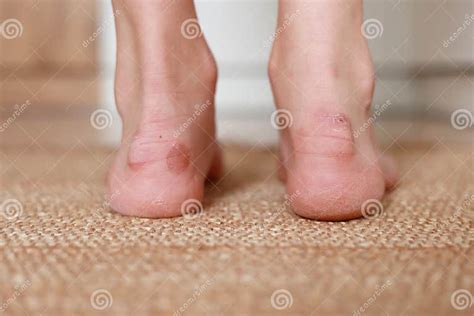 Callus Blisters On Woman Feet Painful Wounds Uncomfortable Shoes