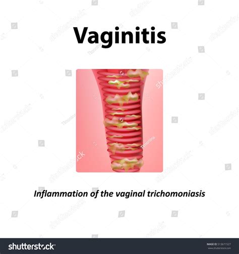 Inflammation Vagina Vaginitis Vaginitis Trichomoniasis Infographics