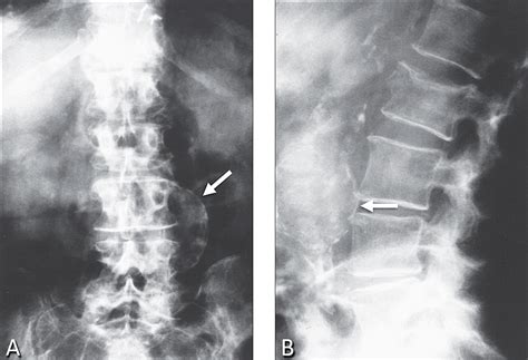 Cureus Abdominal Aortic Aneurysm An Overlooked Etiology Of Low Back Pain