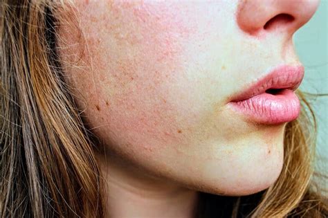 Common Skin Problems On Face