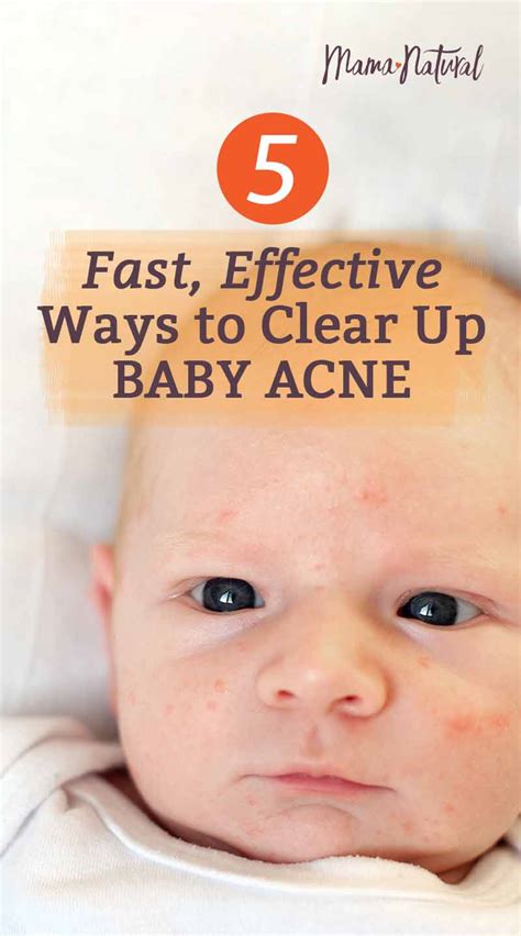 Baby Acne What Causes It And How To Treat Naturally Mama Natural