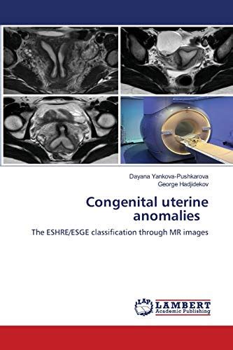 Congenital Uterine Anomalies The Eshreesge Classification Through Mr