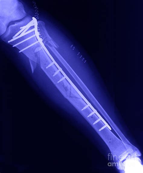 Fractured Tibia Photograph By Ted Kinsman Fine Art America