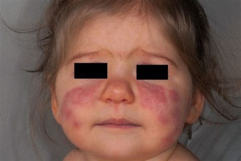 Ab1026 A Rare Case Of Infantile Systemic Lupus Erythematosus In The