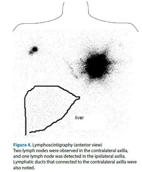 The Management Of Contralateral Axillary Sentinel Lymph Nodes Detected