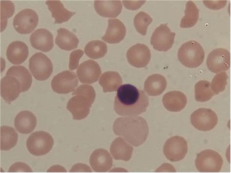 Peripheral Blood Smear Examination Revealing Normocytic Normochromic