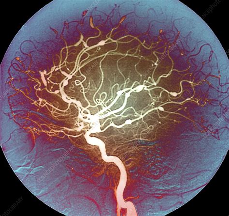 Cerebral Aneurysms In Lupus Angiogram Stock Image C Science Photo Library
