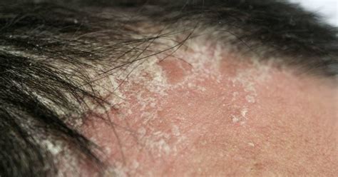 Psoriasis And Hair Loss Scalp Psoriasis Symptoms Prevention