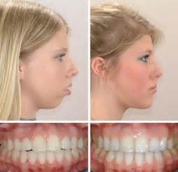 Before And After Double Jaw Surgery Dental Braces Orthognathic Surgery