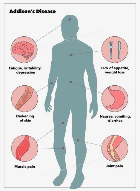[figure Addison S Disease Symptoms Statpearls Publishing Illustration] Statpearls Ncbi