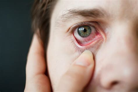 6 Major Causes Of Itchy Eyes At Night Healthpulls