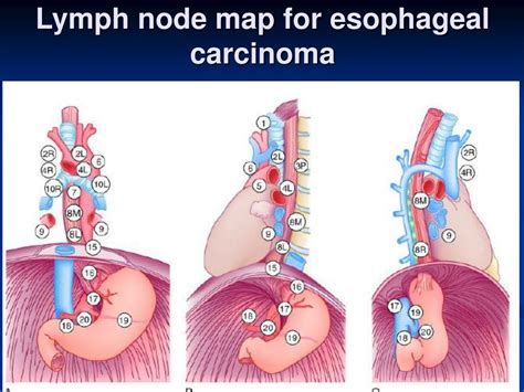 Ppt Esophageal Carcinoma Powerpoint Presentation Free Download Id