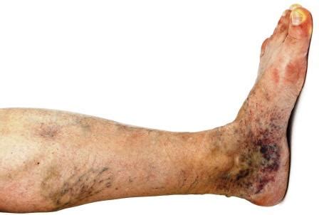 Significados de variscosity en diccionario español inglés : Varicose Veins - Ayurvedic Treatment, Herbs, Home Remedies