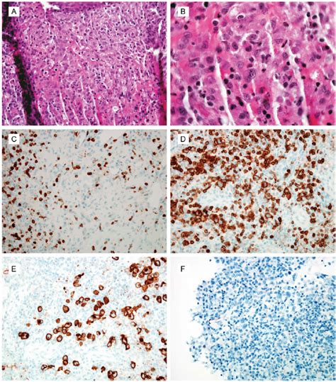 Anaplastic Large Cell Lymphoma Alk Negative From Left Main Bronchus