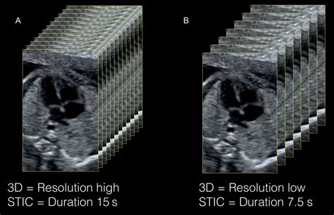 Three And Four Dimensional Ultrasound Of The Fetal Heart Obgyn Key