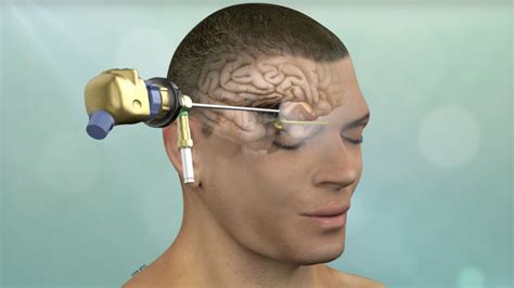 Minimally Invasive Brain Surgery Keyhole Craniotomy Pacific Brain