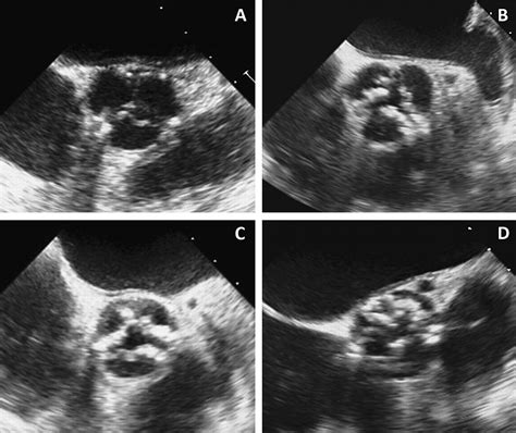 Intraoperative 2d And 3d Transoesophageal Echocardiographic Predictors